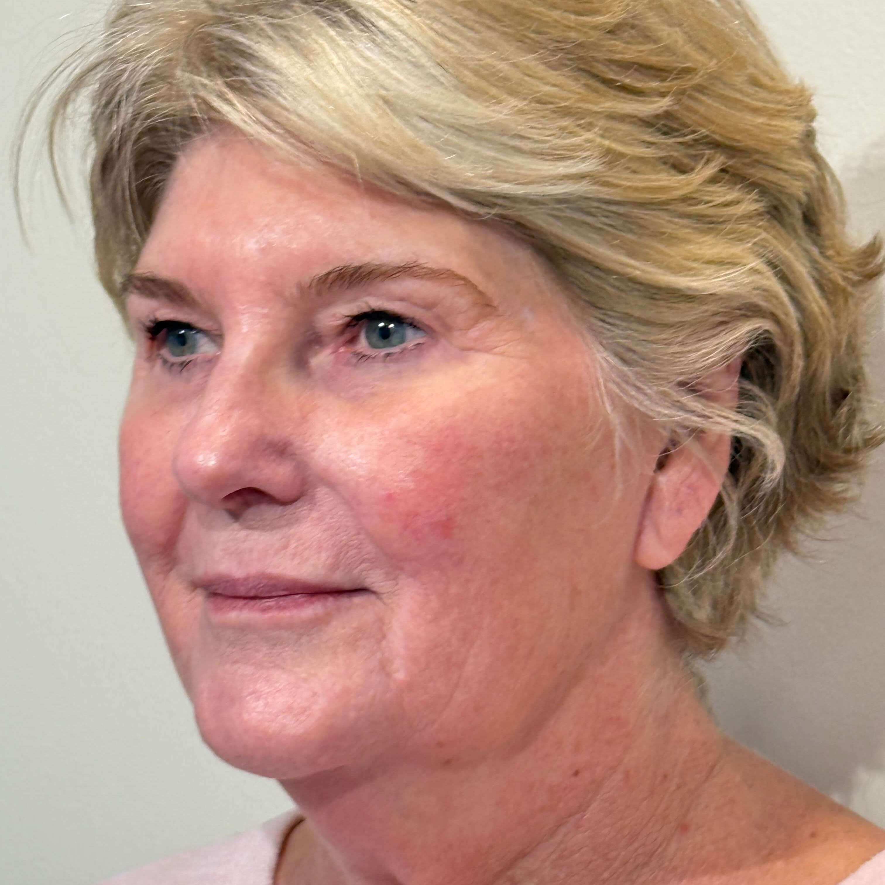 Final Results after HIFU FACEL