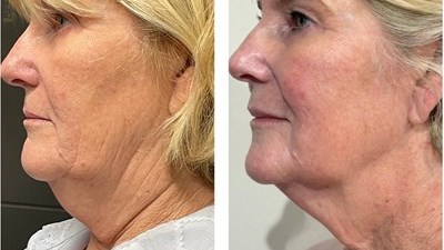 Collagen Stimulation treatment