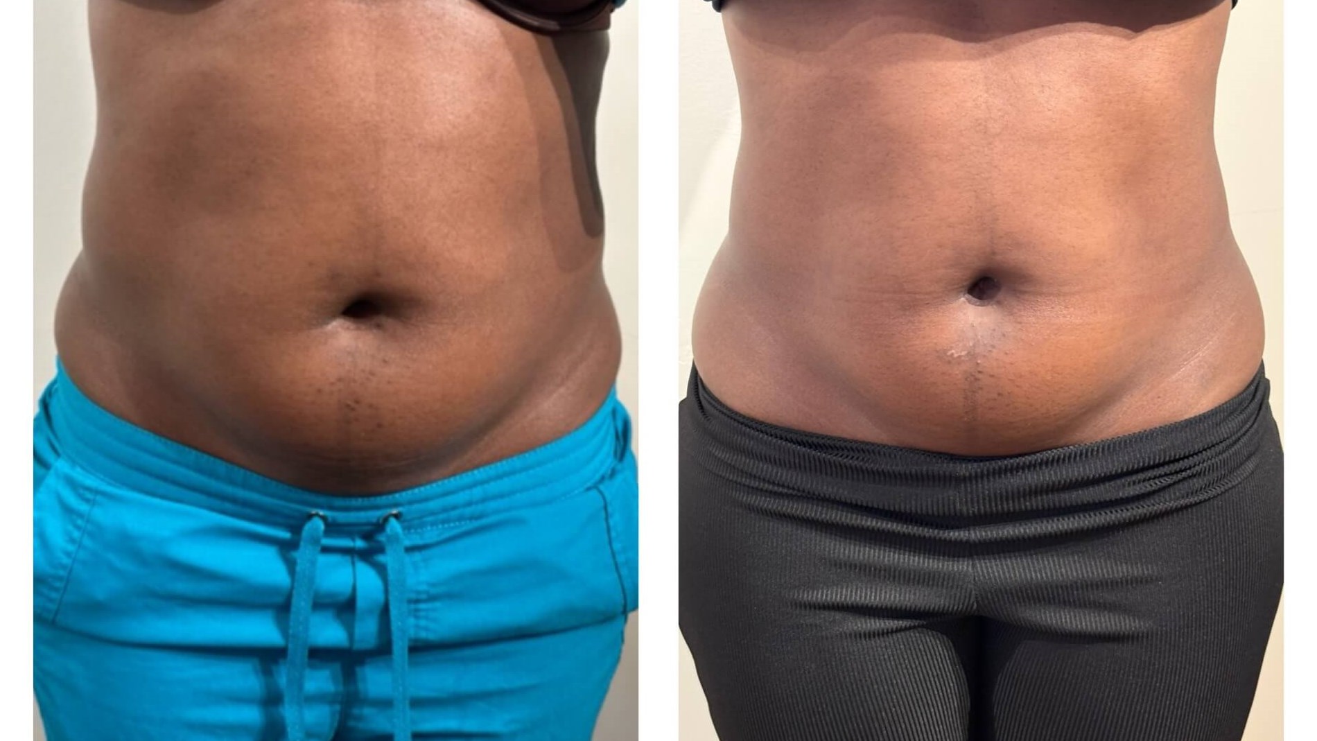 Fat Loss and Skin Tightening o