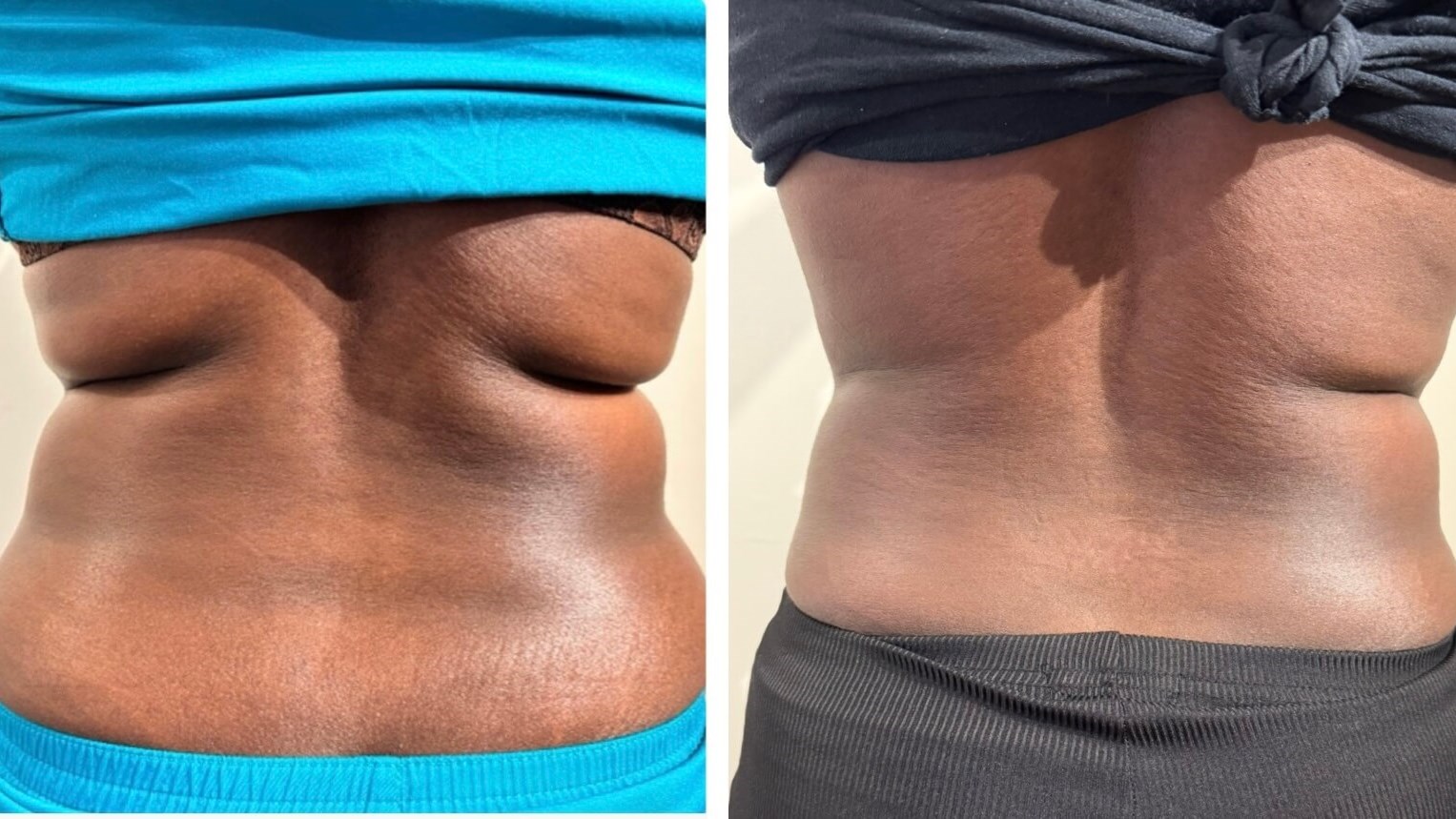 Reducing Back Fat and Tighteni