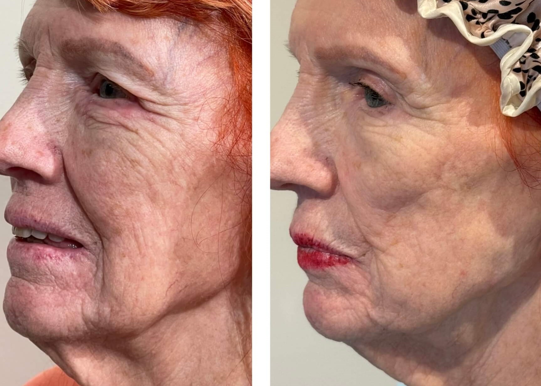 Results from Collagen Stimulat