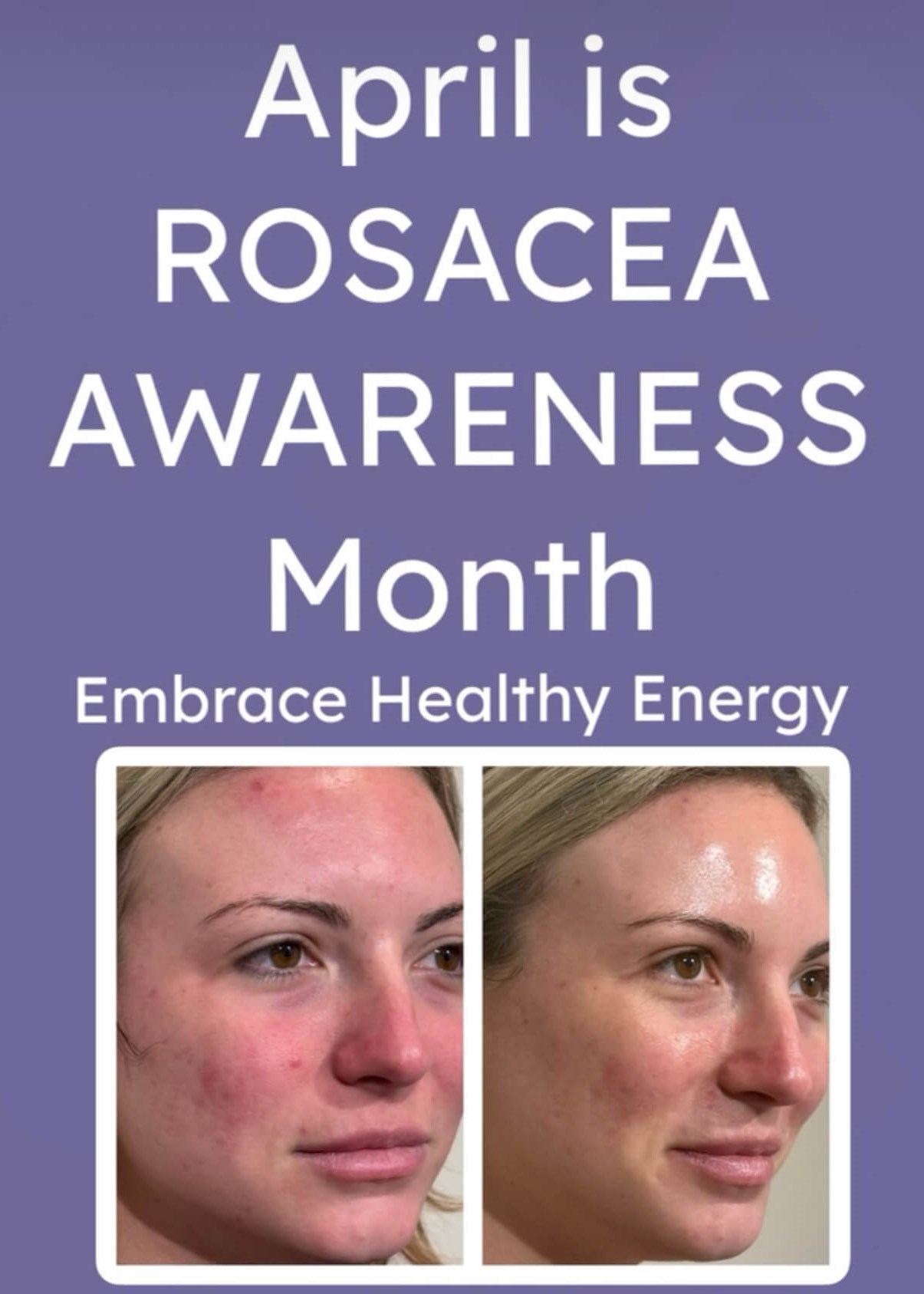 April is Rosacea Awareness mon