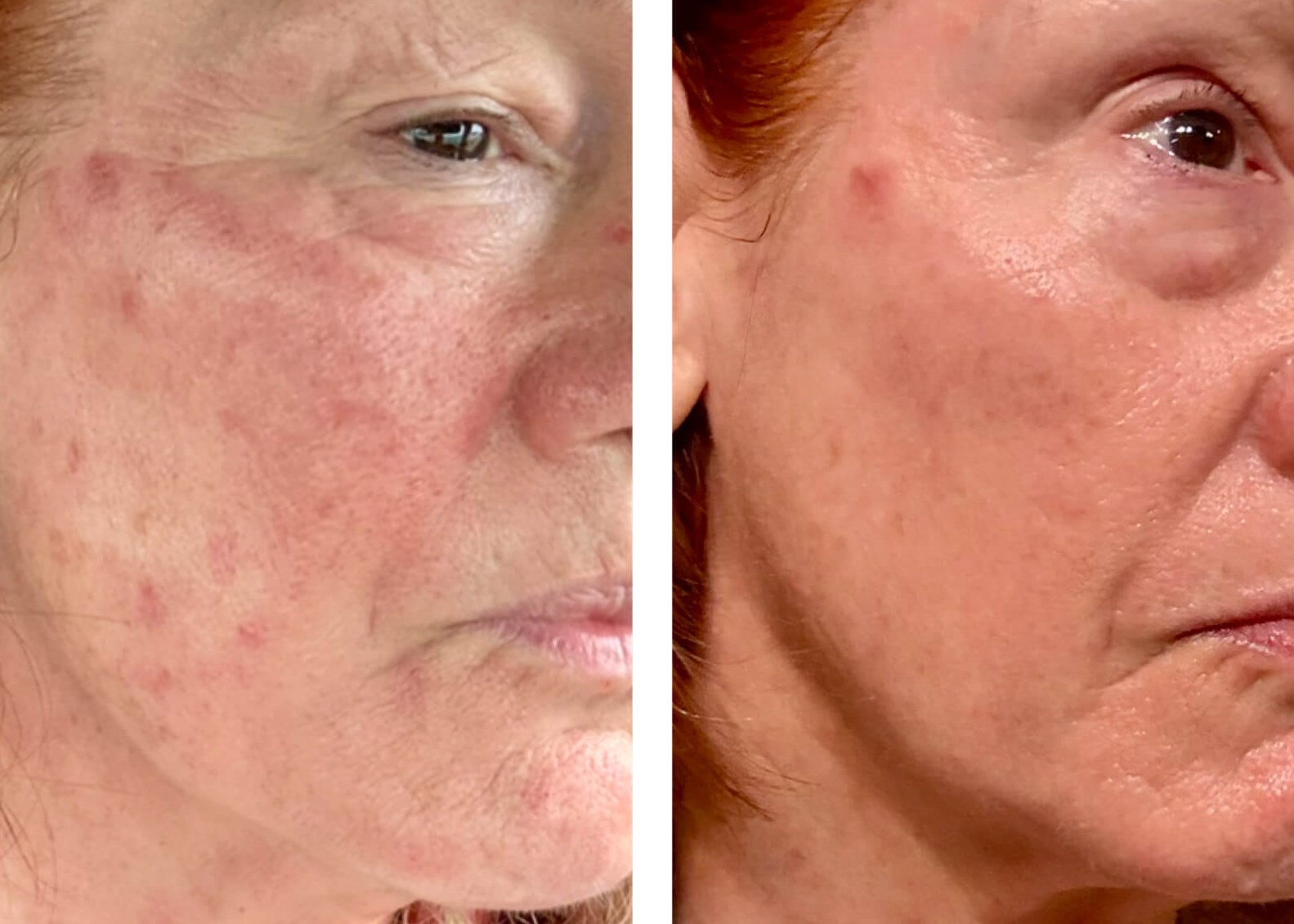 18 Hrs post Microneedling