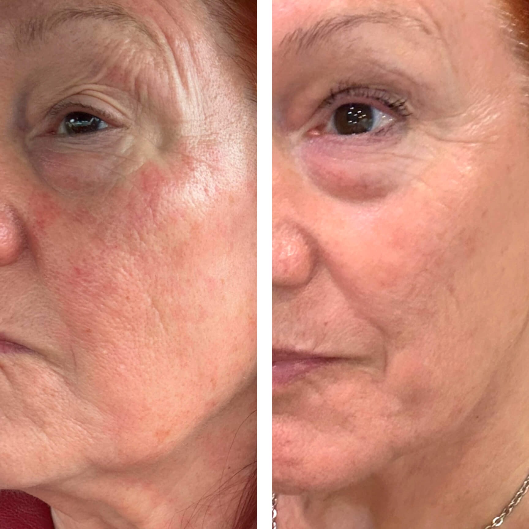 24 Hrs post Microneedling