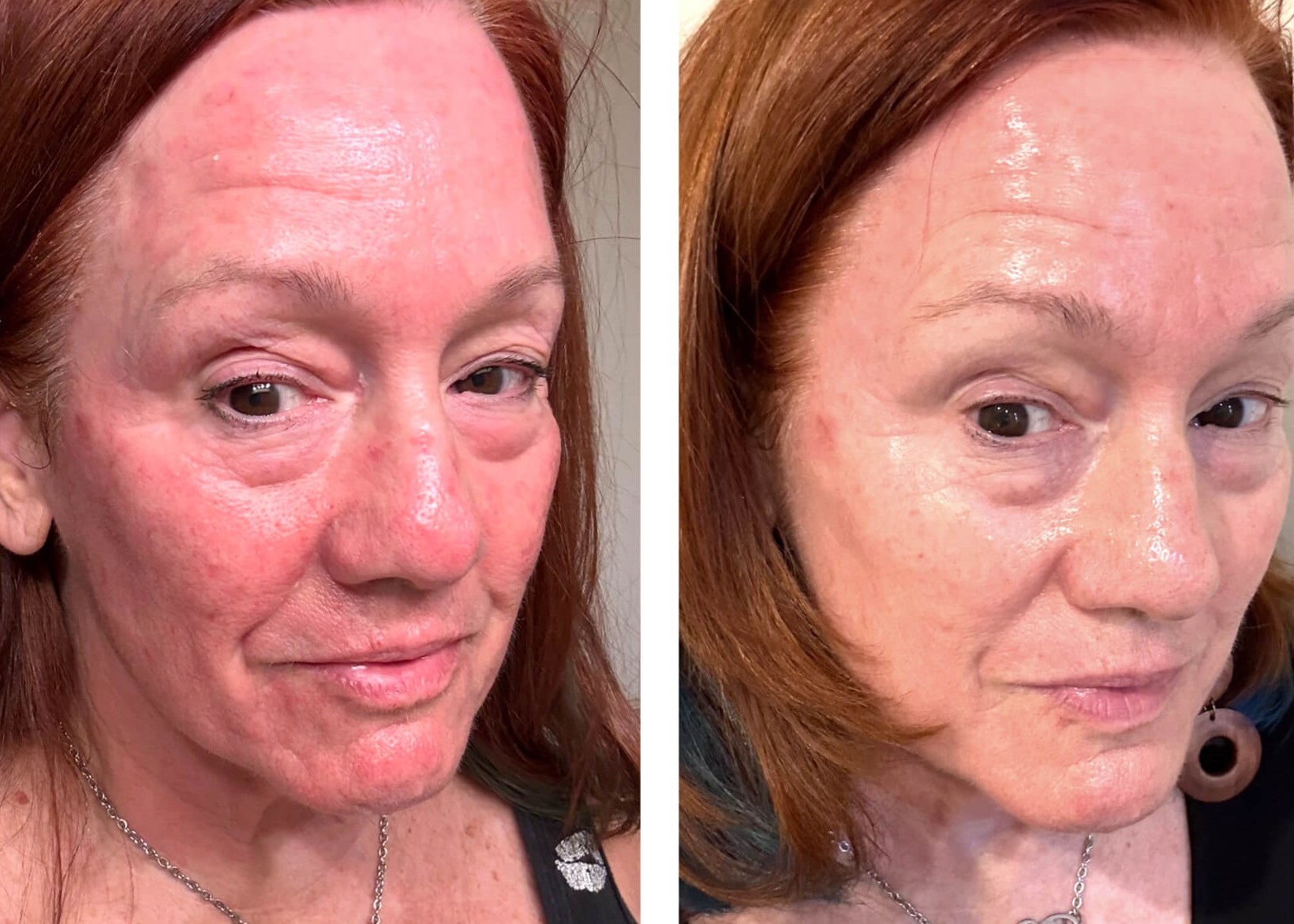 4 hrs Post Microneedling